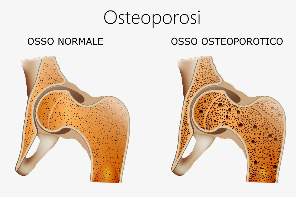 controllo-osteoporosi-messina